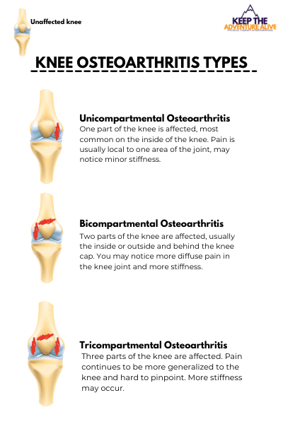 tricompartmental osteoarthritis